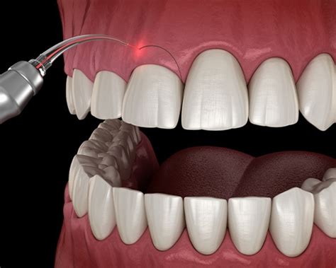 gum regeneration in summerlin nv